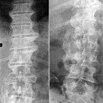 Spondylarthrite ankylosante