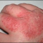 Eczéma