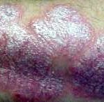 Psoriasis