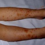 Les vascularites