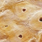 Arthrose