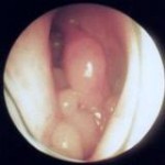 Polype nasal