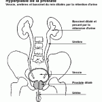 Hypertrophie prostate