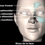 Sinusite