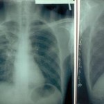 Tuberculose