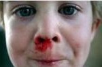 Epistaxis de l’enfant