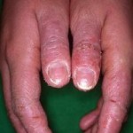les dermites de contact