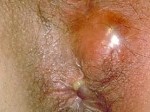 Fistule anale