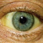 Diagnostic d’un ictère, hépatites
