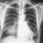 Vaccin pneumococcique