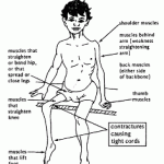 Diphtérie + Tétanos + Polio