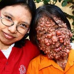Les neurofibromatoses