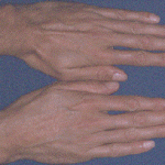 Les syndromes dysmorphiques