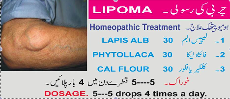 Lipoma