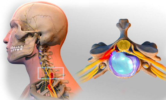 Cervicobrachialgie